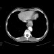 Carcinoma of oesophagus and cardia: CT - Computed tomography